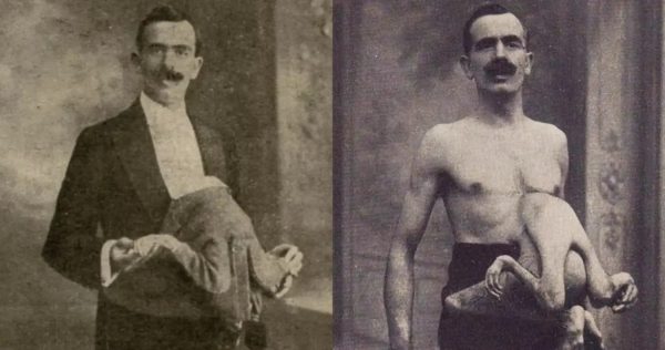 странностите на съдбата: историята на човека с две тела