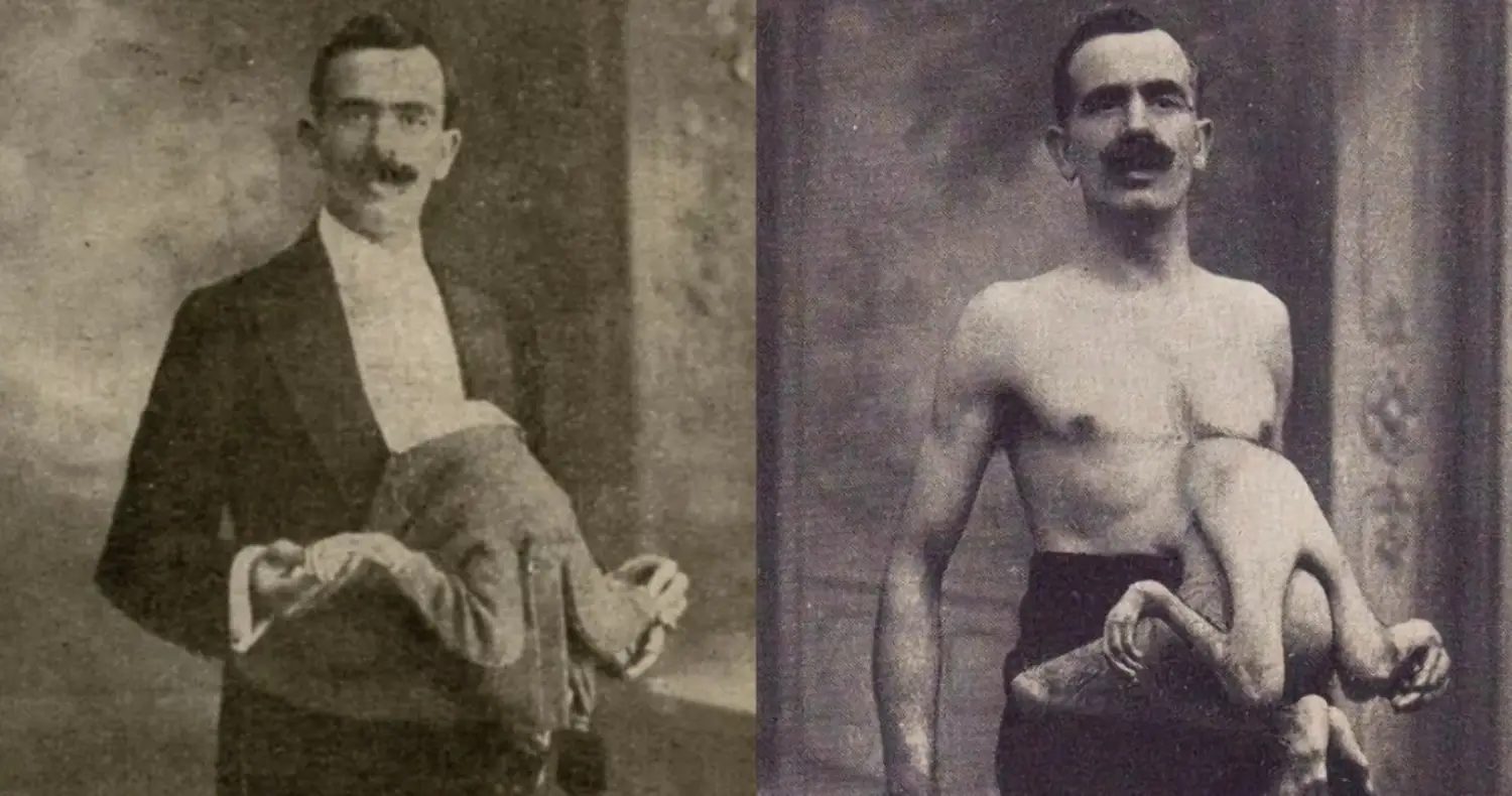 странностите на съдбата: историята на човека с две тела